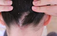 дерматит на голове