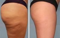 антицеллюлитный массаж