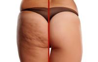 до и после целлюлитной борьбы